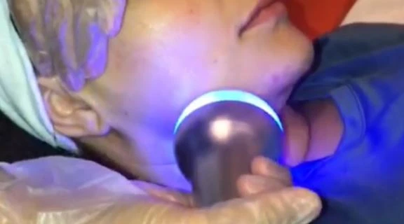 Cryoskin 3.0