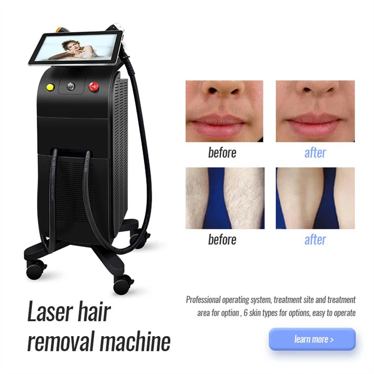 Titan-Laser-Haarentfernung