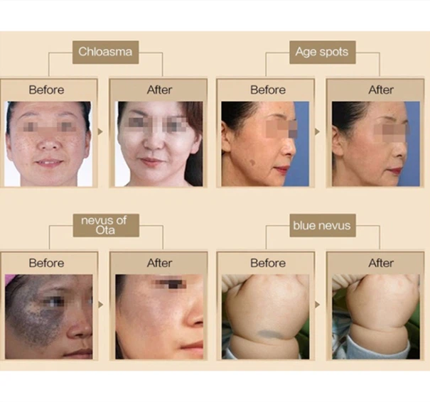 Picosecond Tattoo Removal