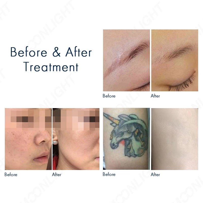2 in 1 ND YAG + Diode Laser Hair Removal Machine