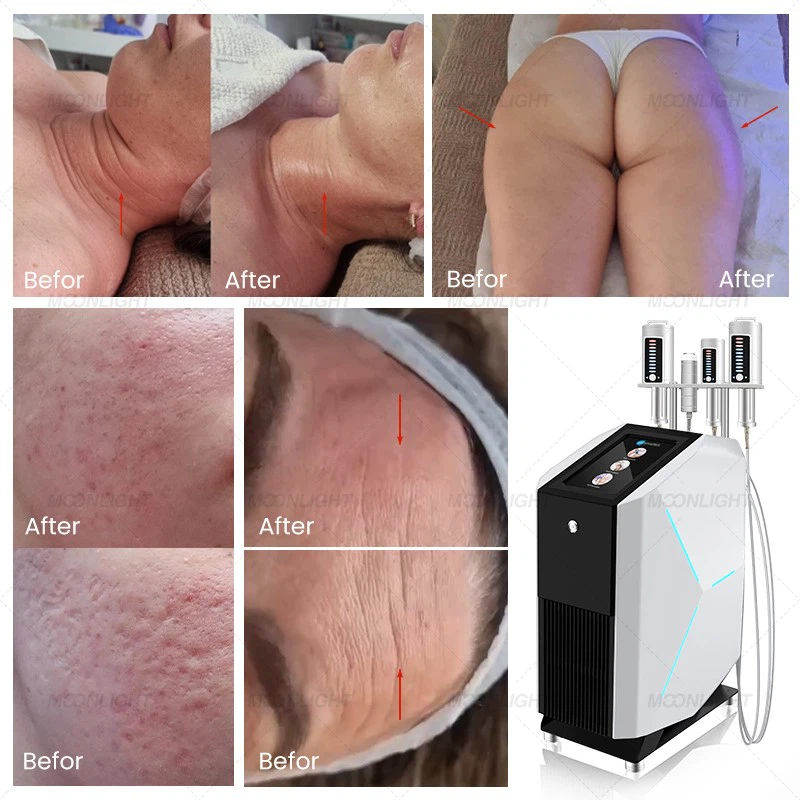 Endosfera Roller Massage Machine