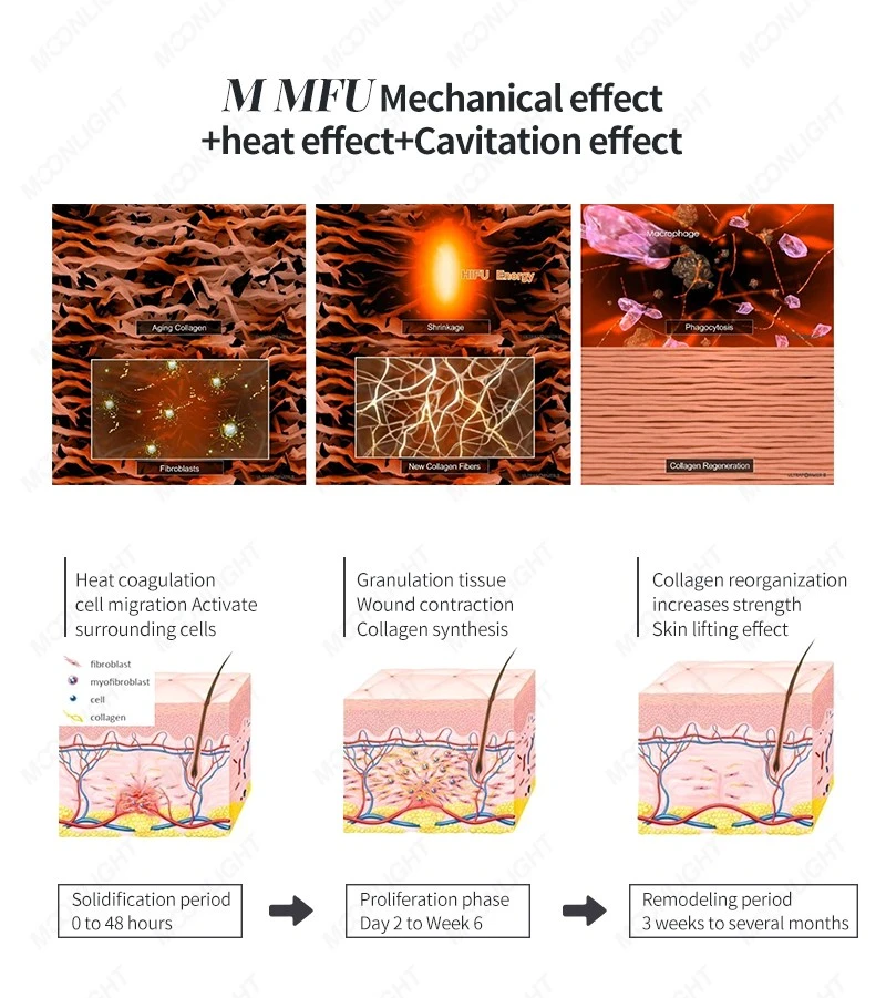 MNLT 7D HIFU Machines – Non-Surgical Facial Lifting, Firming, And Body Contouring Solution factory